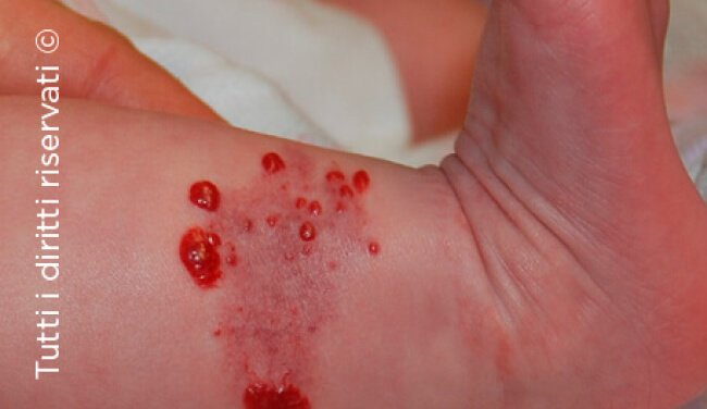Infantile haemangioma