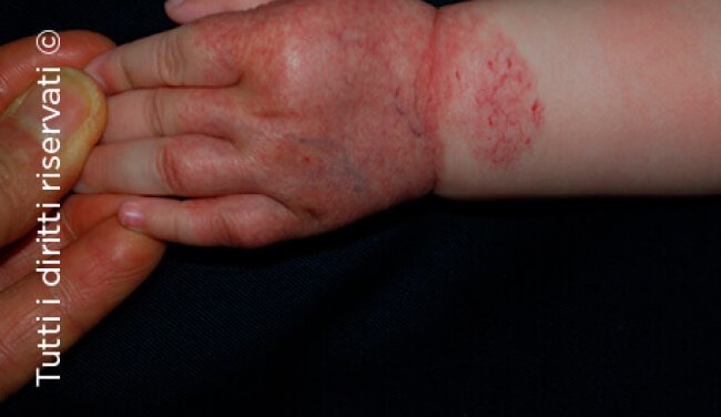 Infantile haemangioma