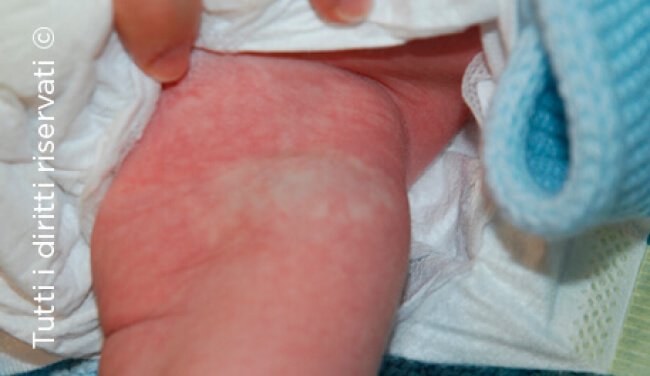 Infantile haemangioma