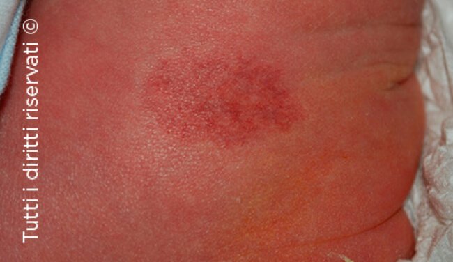 Infantile haemangioma