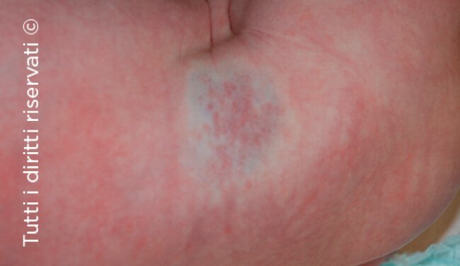 Infantile haemangioma