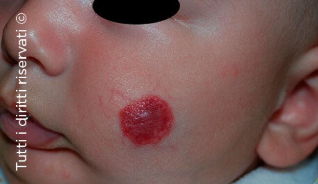 Infantile haemangioma