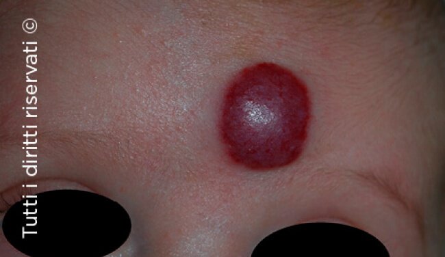 Infantile haemangioma