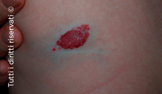 Infantile haemangioma