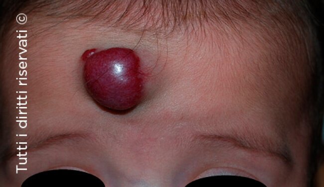 Infantile haemangioma