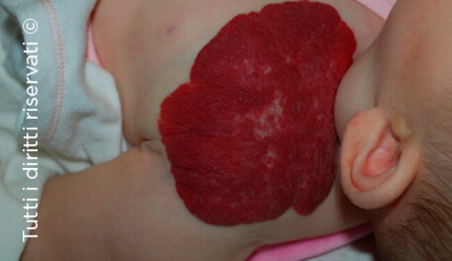 Infantile haemangioma