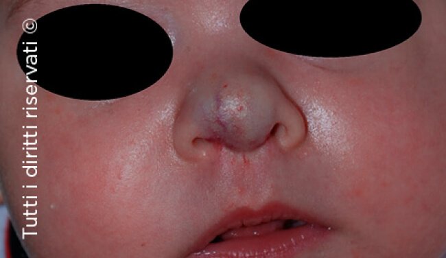 Infantile haemangioma