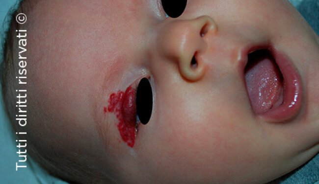 Infantile haemangioma