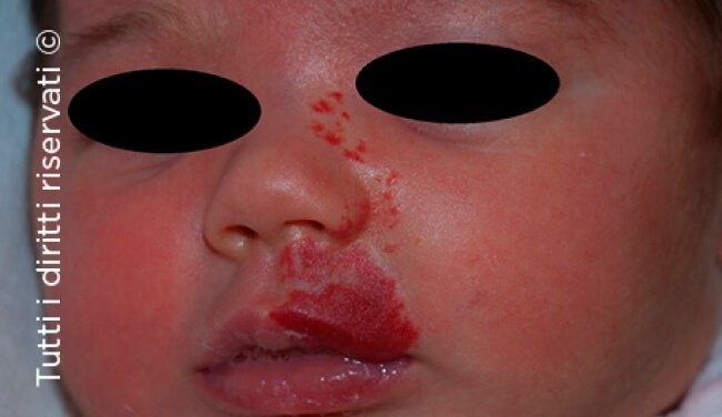 Infantile haemangioma