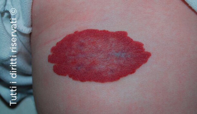 Infantile haemangioma