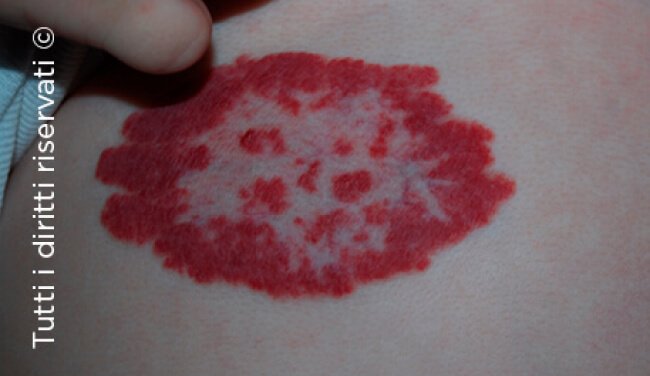 Infantile haemangioma