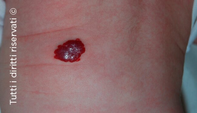 Infantile haemangioma