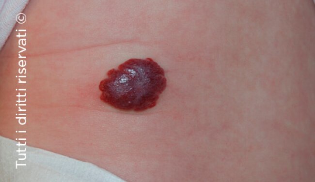 Infantile haemangioma