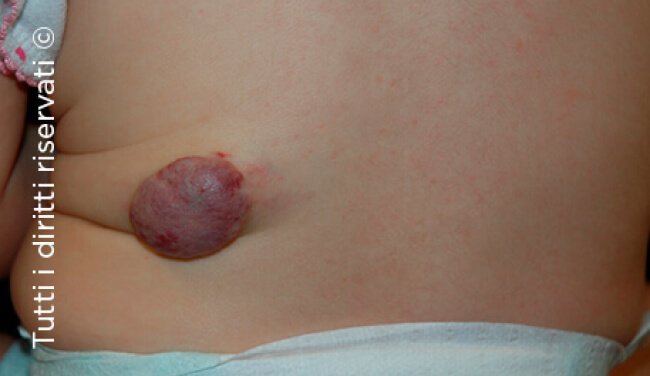 Infantile haemangioma