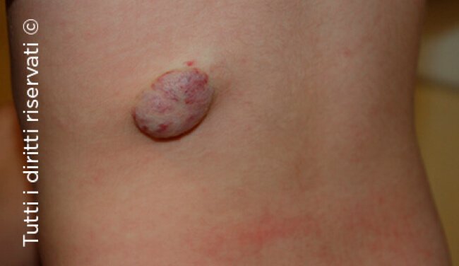 Infantile haemangioma