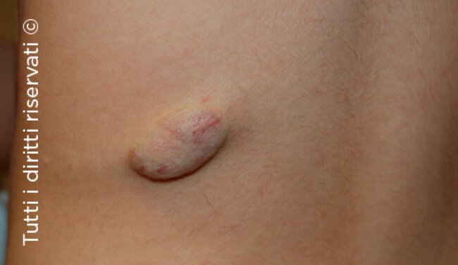 Infantile haemangioma