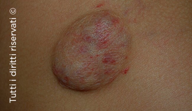 Infantile haemangioma