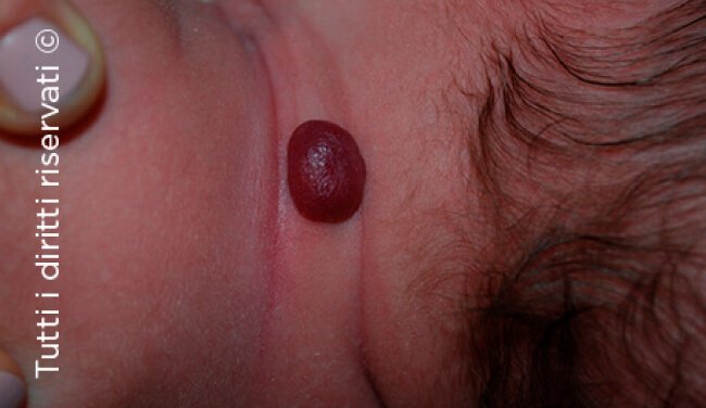 Infantile haemangioma