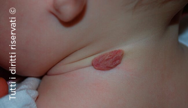 Infantile haemangioma