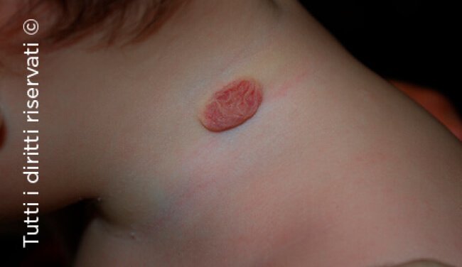 Infantile haemangioma