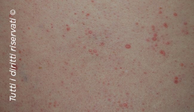 Lichen planus