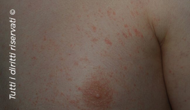 Lichen planus