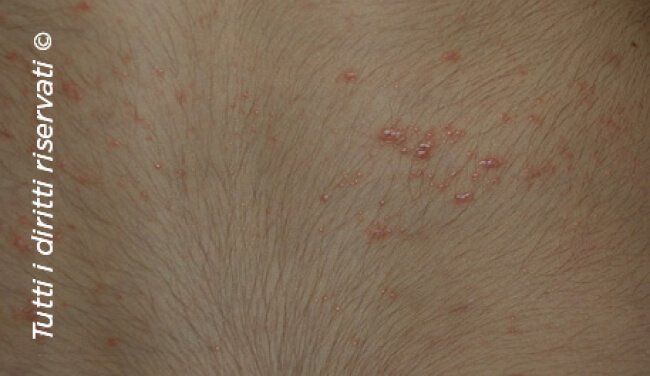 Lichen planus