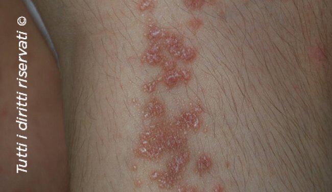 Lichen planus