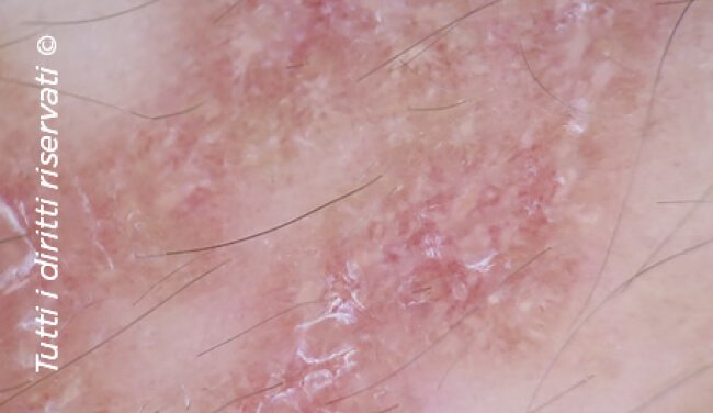 Lichen planus
