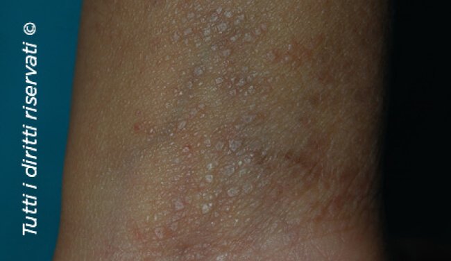 Lichen planus