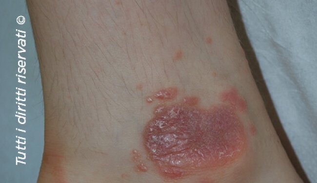 Lichen planus