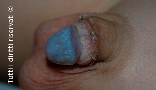 Lichen Sclerosus