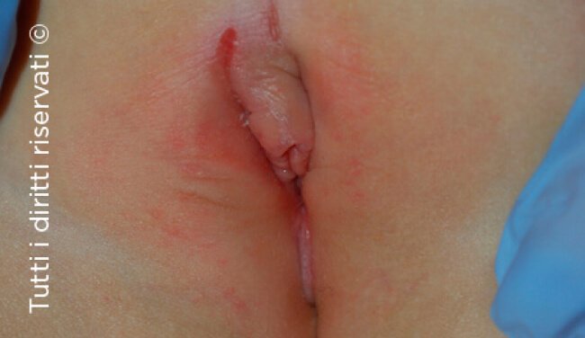 Lichen Sclerosus