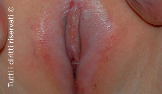 Lichen Sclerosus