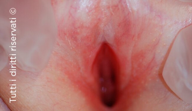 Lichen Sclerosus
