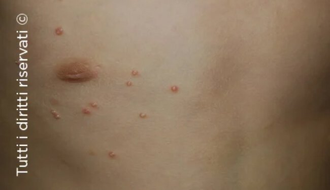 Molluscum Contagiosum