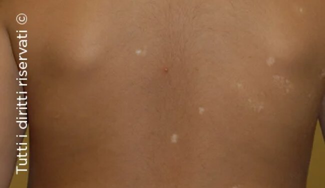 Molluscum Contagiosum