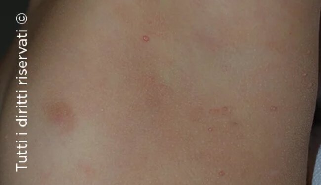 Molluscum Contagiosum