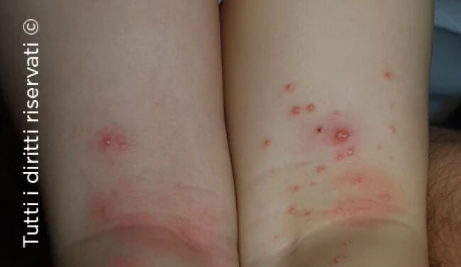 Molluscum Contagiosum