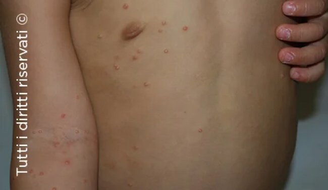 Molluscum Contagiosum
