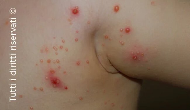 Molluscum Contagiosum