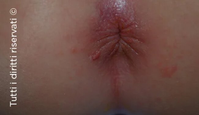 Molluscum Contagiosum