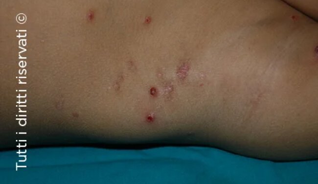 Molluscum Contagiosum