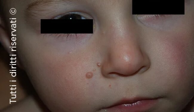 Molluscum Contagiosum