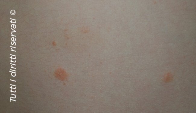Pityriasis rosea