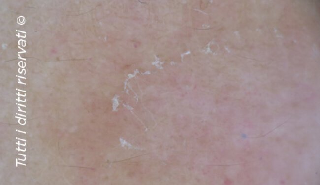 Pityriasis rosea