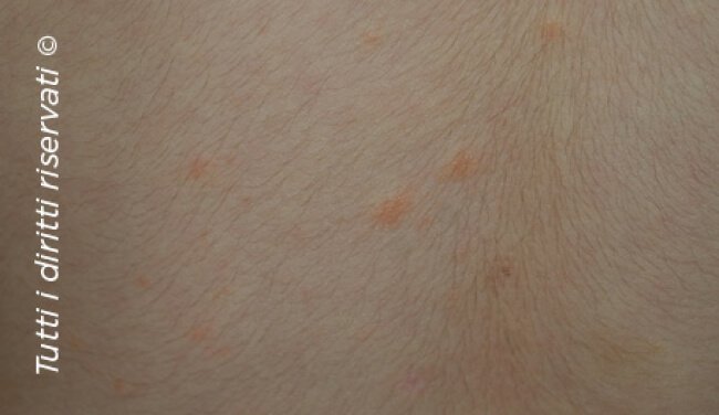 Pityriasis rosea