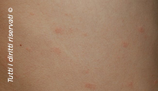 Pityriasis rosea