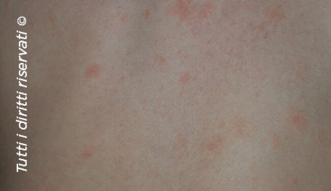 Pityriasis rosea