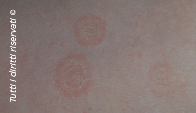 Pityriasis rosea